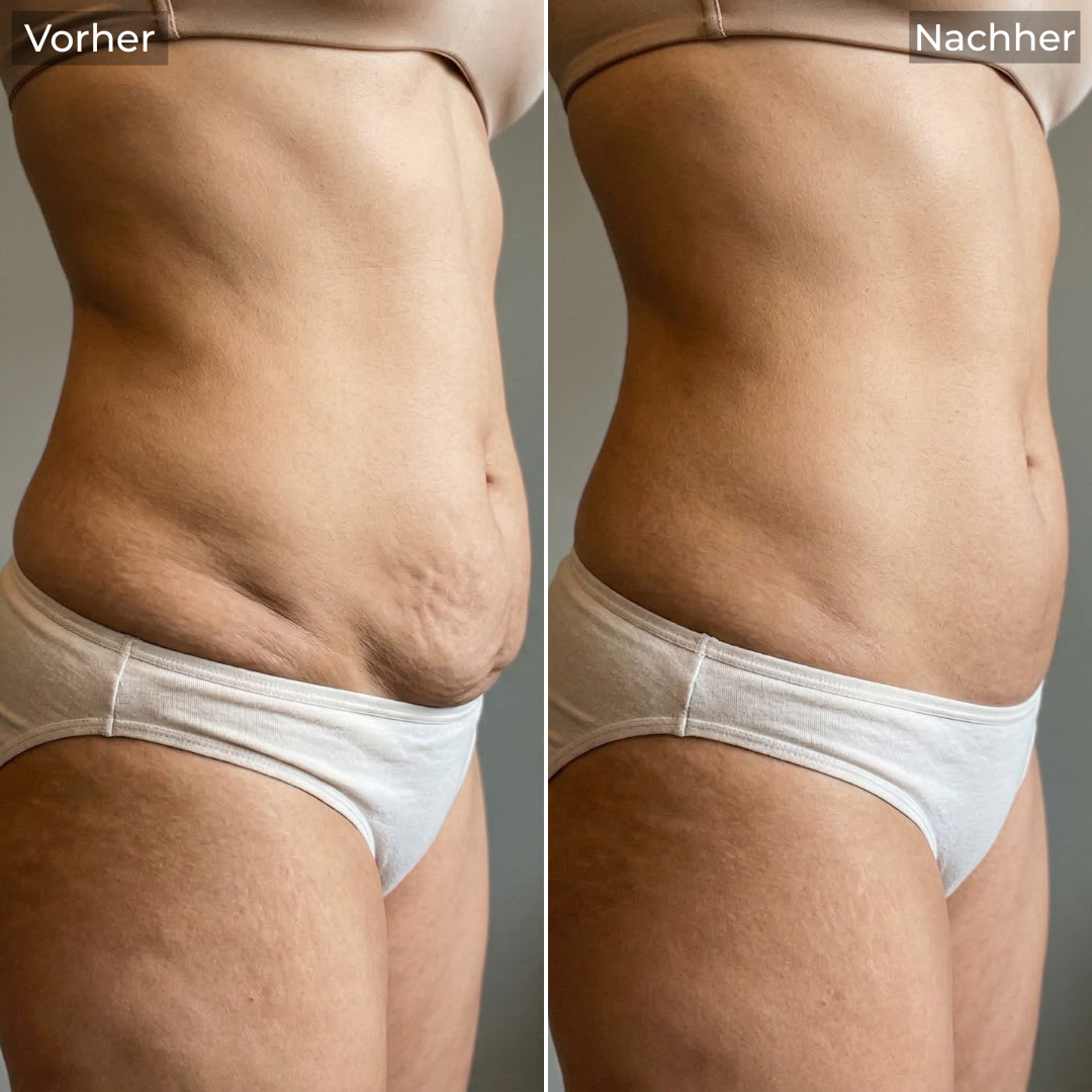 Anti-Cellulite Gerät - Straffung mit Vakuum, EMS & LIPO